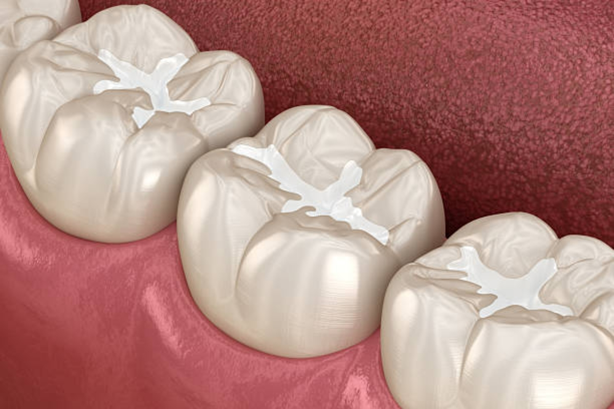 Tooth-Colored Fillings: The Aesthetic Upgrade from Metal Fillings
